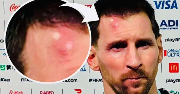 Messi sưng vều trán sau trận thắng Cabo Verde: Chấn thương nhỏ hay dấu hiệu đáng lo? - hình ảnh - winxx88.vip Messi sưng vều trán sau trận thắng Cabo Verde: Chấn thương nhỏ hay dấu hiệu đáng lo? - hình ảnh - winxx88.vip